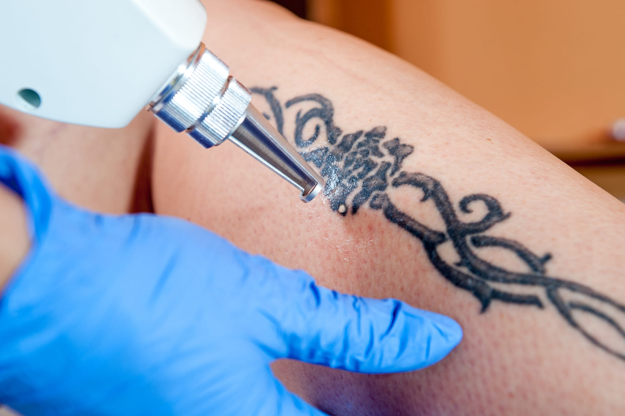 Remoção de tatuagem 